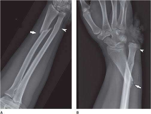 Fracture Treatment by Orthopaedic Surgeon Wakad Pune